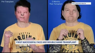 Extremely rare face and double hand transplant gives man new chance at life