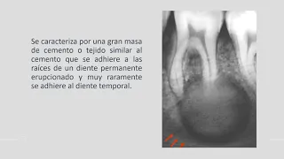 Cementoblastoma asociado al segundo molar primario: reporte de un caso inusual