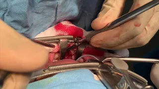 How a hole from the mouth to the nose is closed in this fistula closure surgery to improve speech