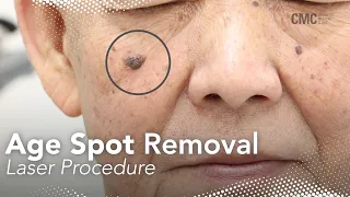 Laser Keratosis Removal | Cosmetic Medical Clinic CMC NSW