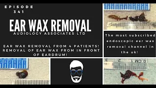 EAR WAX REMOVAL FROM 4 PATIENTS - DEEP EAR WAX IN FRONT OF THE EARDRUM - EP 341