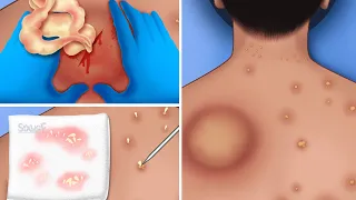 ASMR Remove back big pustule and pimple popping | Acne animation