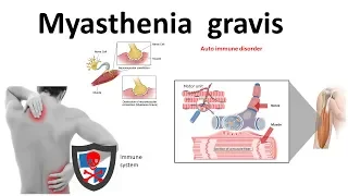 Autoimmune disorders: Myasthenia Gravis