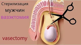 Вазэктомия, Стерилизация мужчин.  Vasectomy.