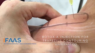 IFAAS Exclusive Technique - Botox-A Injection for Trapezius Contouring