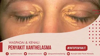 Info Penyakit Xanthelasma