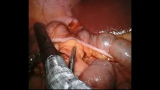 Robotic Ileocolic Resection with Intracorporeal Anastomosis for Complex Crohn’s Disease