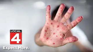 Health expert explains why Metro Detroit is seeing a rise in measles cases