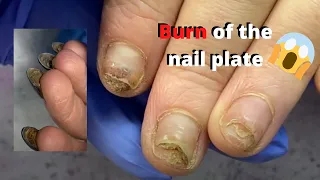 Burn of the nail plate /  Onycholysis of nails