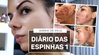 DIÁRIO DAS ESPINHAS (ACNE) SEM ROACUTAN