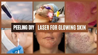 Skincare Routine For Glowing spotless Skin - Salicylic Peeling and Laser Resurfacing