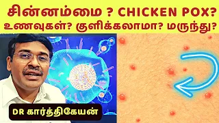Chickenpox: Causes, Symptoms, and Prevention | சின்னம்மை