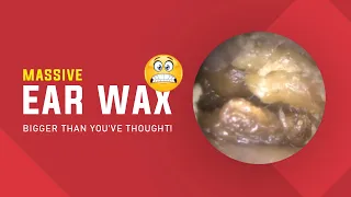 Ear Wax Removal 402: How Can He Get This Massive Ear Wax Out?!!
