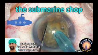 Mohanta's Submarine Chop for dense brunescent cataracts