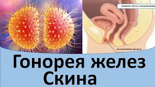 Гонорея желез Скина у женщины