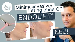 NASOLABIALFALTEN & MARIONETTENFALTEN endlich loswerden mit dem ENDOLIFT®! doc.rolf