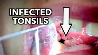 HIS INFECTED TONSILS WERE ALMOST TOUCHING! | Dr. Paul