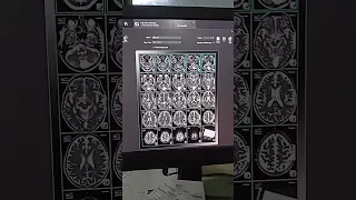 #MRI Brain filming #t2 ' #t1 #Flair #DWI & ADC '#t2 coronal #t1 sagittal