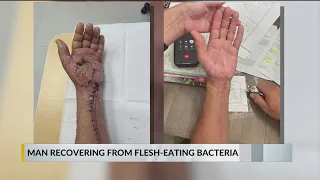Pensacola surgeons save Orange Beach man’s hand from flesh eating bacteria