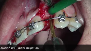 Narrow Site & Piezosurgery implantation