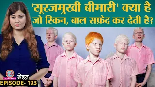 सफेद Skin, Hair वाले देखे होंगे, पर ये Albinism कौन सी बीमारी है, किसे हो सकती है? | Sehat ep 193