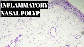 Inflammatory Nasal Polyp