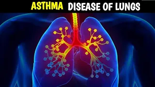 Asthma Lungs Disease | Symptoms | | Causes & Treatment