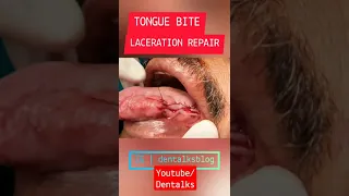 #shorts #youtubeshorts Tongue Bite Laceration Repair