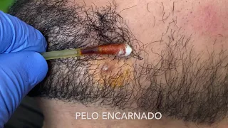 PELO ENCARNADO