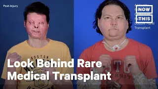 22-Year-Old Undergoes Rare Face and Hands Transplant