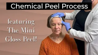The Chemical Peel Process (+ Day By Day Healing!)