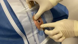 How to properly use a Perforated Eye Drape in cataract surgery