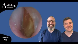 EPIC EAR WAX PEEL FROM EARDRUM - EP 798