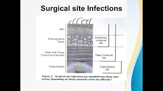 Surgical site infections