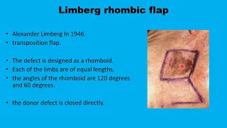 (19) Limberg Rhomboid Flaps in Head and Neck reconstruction