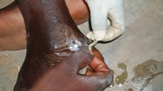 3 million cases of Guinea worm disease  Guinea worm is going down?