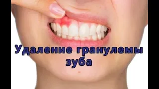 Удаление или лечение гранулемы зуба