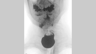 Swallowing disorders - Zenkers diverticulum