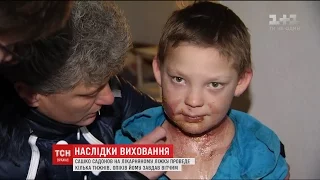 В опіковому відділені Київської лікарні обстежили Сашка Садонова, якого жорстоко виховував вітчим