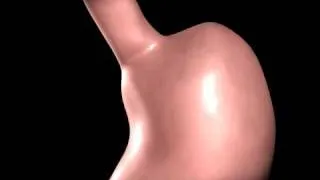 Gastric Bypass animation