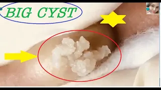 #acne removal_BIG CYST  on the ears (ep 14)