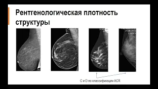 МАММОГРАФИЯ Лекция «Скрининг рака молочной железы»