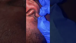 Blackhead Extraction 2021