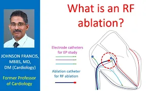 What is RF ablation?