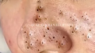 Blackhead Removal With Sac Dep Spa