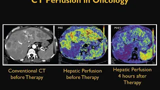 CT Perfusion