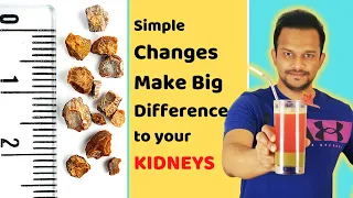 5 SIMPLE HABITS For Kidney Stone Free Life | Prevent Kidney Stones, Dissolve & Pass It Without Pain