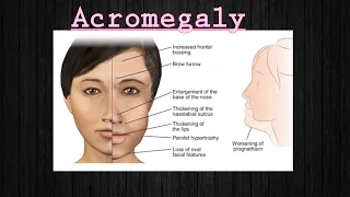 Acromegaly|•Medx•|