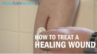 How to care for a healing wound