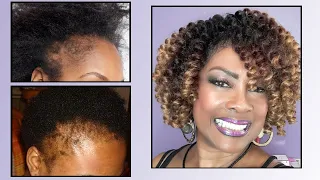 Traction Alopecia around your hairline | Now you can wear crochet styles that look oh so natural!
